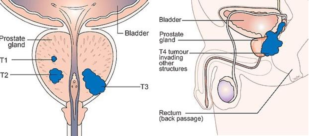 Prostate Tumor